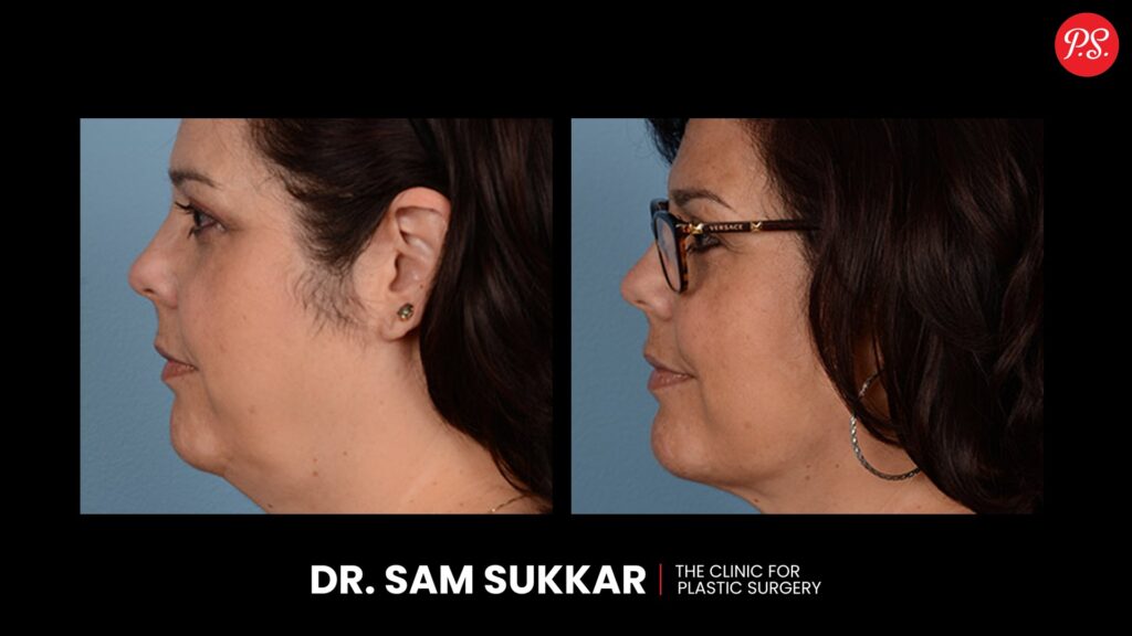 Neck Liposuction Before and After Transformations in Houston, TX by Dr. Sam Sukkar, MD