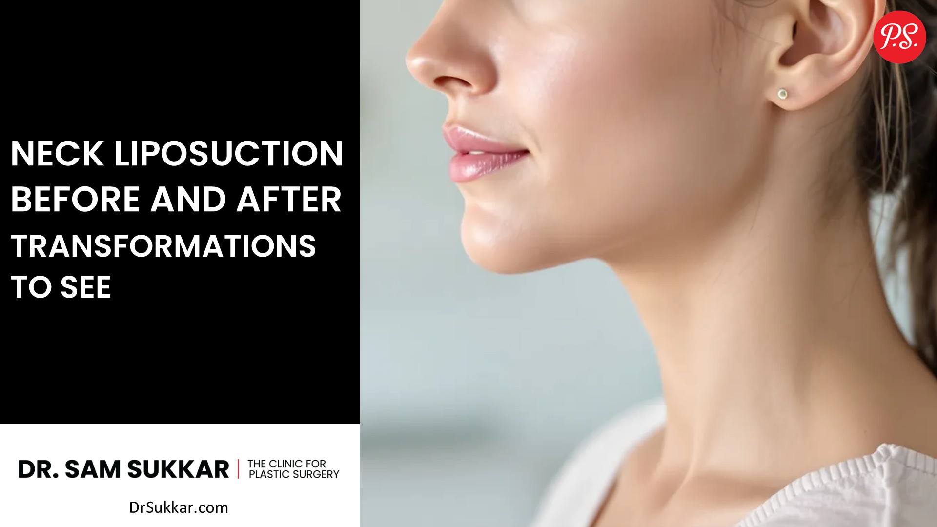 Neck Liposuction Before and After Transformations to See