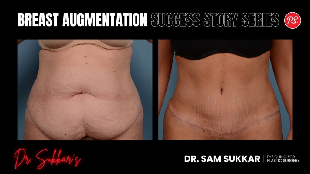 Tummy Tuck Success: Friend Referral Led to Life-Changing Results - Mommy Makeover Success Story Series by Dr. Sam Sukkar, MD in Houston, Texas