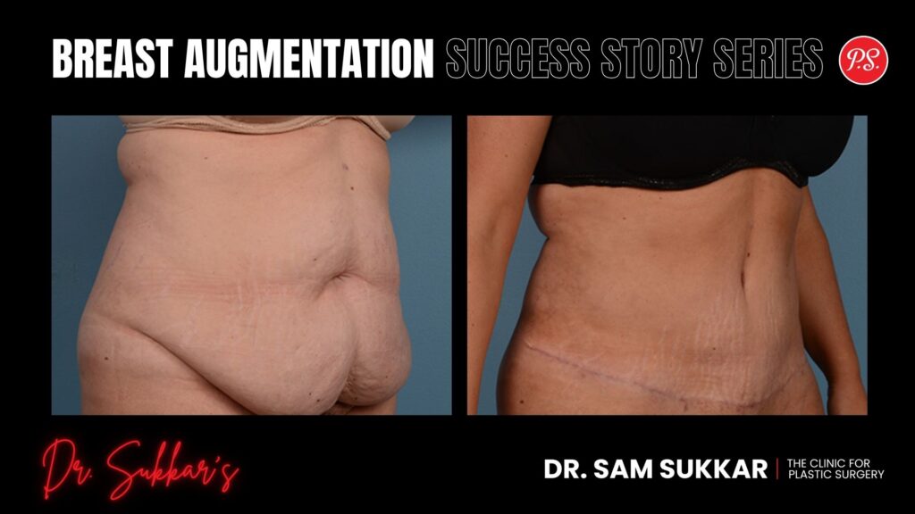 Tummy Tuck Success: Friend Referral Led to Life-Changing Results - Mommy Makeover Success Story Series by Dr. Sam Sukkar, MD in Houston, TX