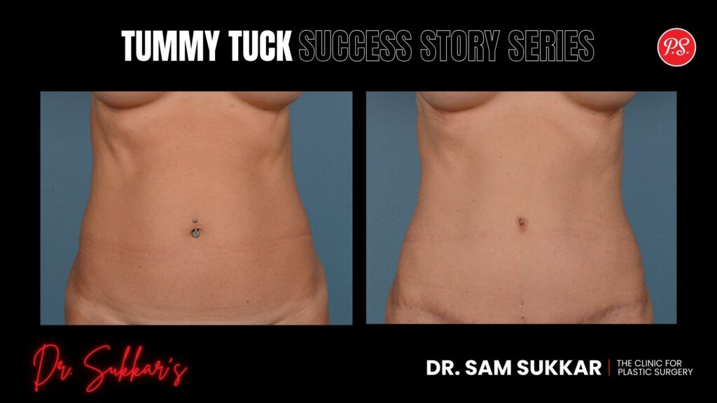 Tummy Tuck at 60: Houston Woman’s Remarkable Transformation - Tummy Tuck Success Story Series in Houston, Texas by Dr. Sam Sukkar, MD