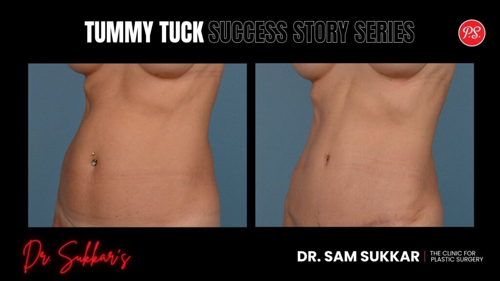 Tummy Tuck at 60: Houston Woman’s Remarkable Transformation - Tummy Tuck Success Story Series in Houston, TX by Dr. Sam Sukkar, MD