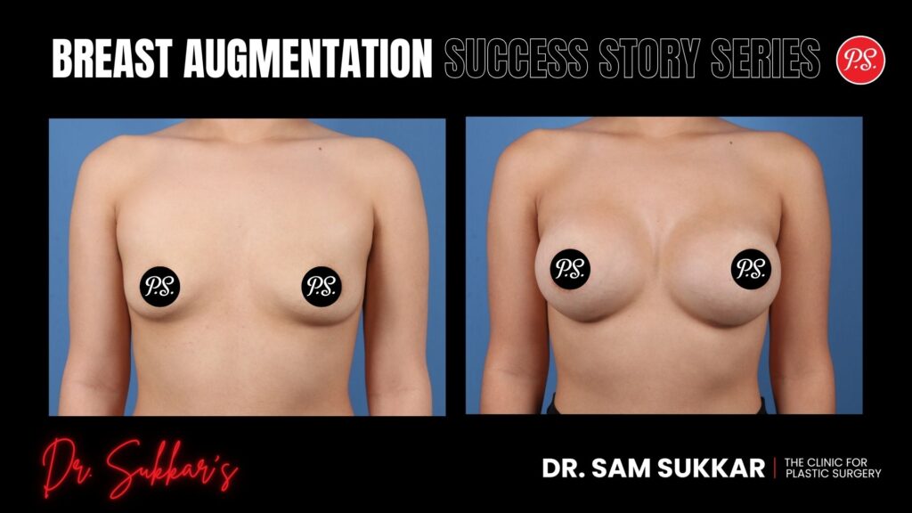 Breast Augmentation at 24: Petite Houston Patient's Journey - Breast Augmentation Success Story Series in Houston, Texas by Dr. Sam Sukkar, MD