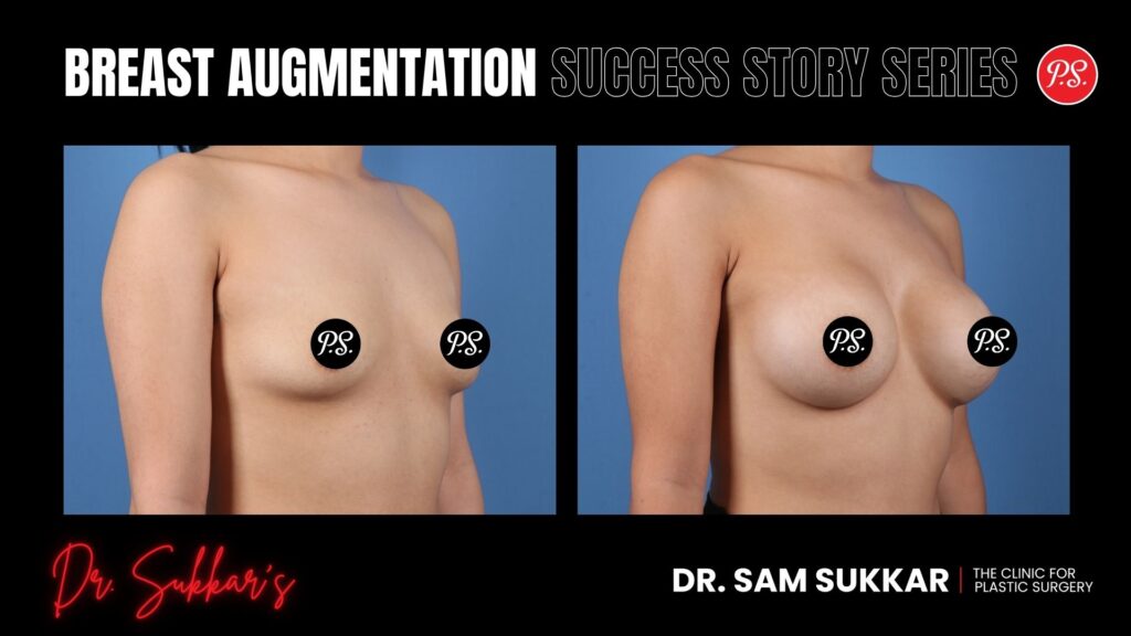 Breast Augmentation at 24: Petite Houston Patient's Journey - Breast Augmentation Success Story Series in Houston, TX by Dr. Sam Sukkar, MD