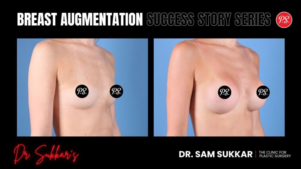 Breast Augmentation at 35: Houston Patient’s Natural Results - Breast Augmentation Success Story Series in Houston, TX by Dr. Sam Sukkar, MD