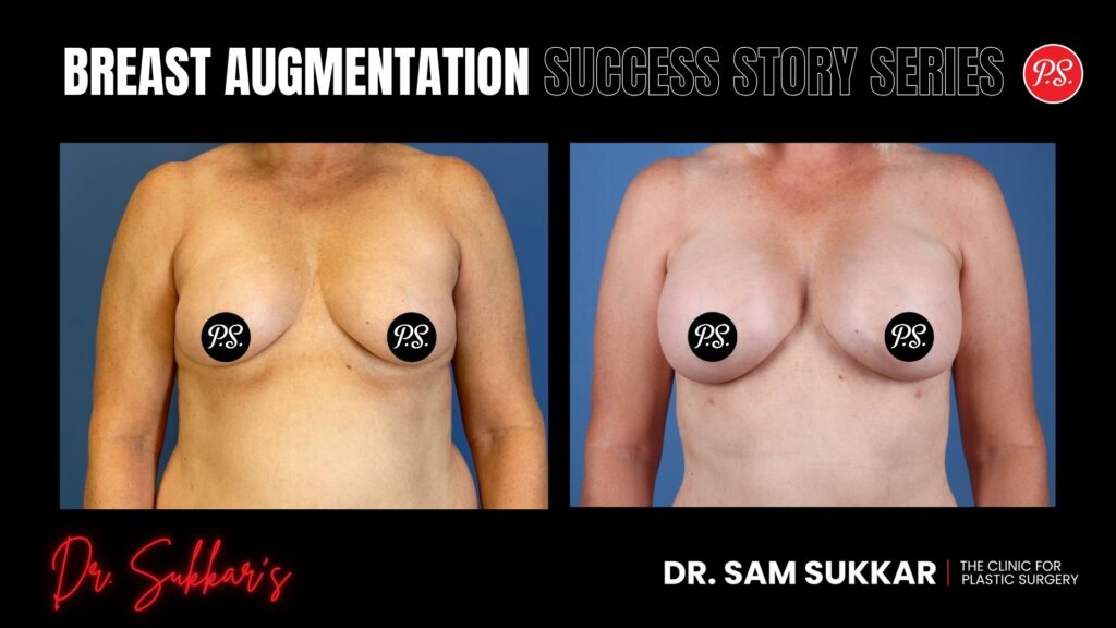 Breast Augmentation at 56: Houston Woman’s Confidence Transformation - Breast Augmentation Success Story Series in Houston, Texas by Dr. Sam Sukkar, MD