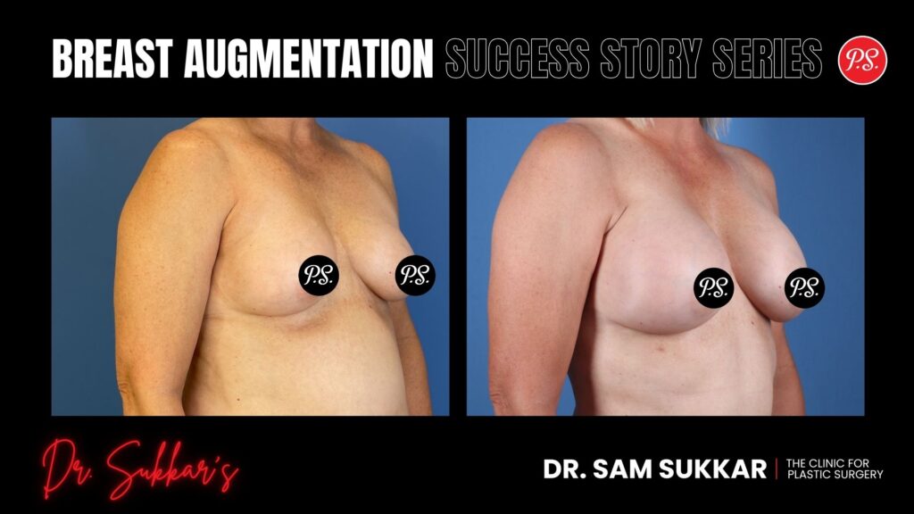 Breast Augmentation at 56: Houston Woman’s Confidence Transformation - Breast Augmentation Success Story Series in Houston, TX by Dr. Sam Sukkar, MD