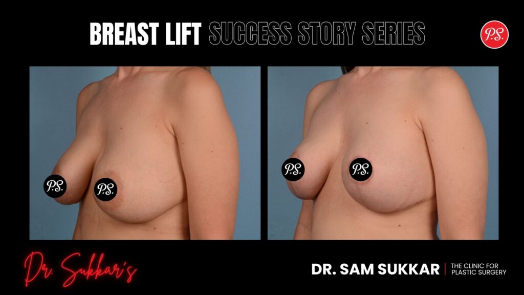 Breast Lift Success: Correcting Asymmetry at 38 in Houston - Breast Lift Success Story Series in Houston, TX by Dr. Sam Sukkar, MD