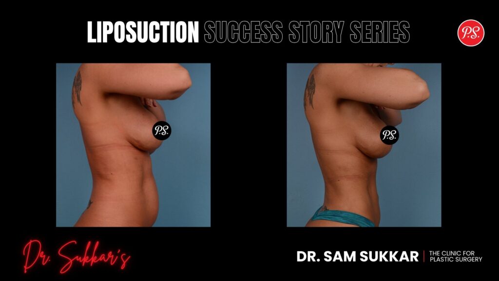 Hi-Definition Liposuction: 43-Year-Old's BBL Transformation - Liposuction Success Story Series in Houston, TX by Dr. Sam Sukkar, MD