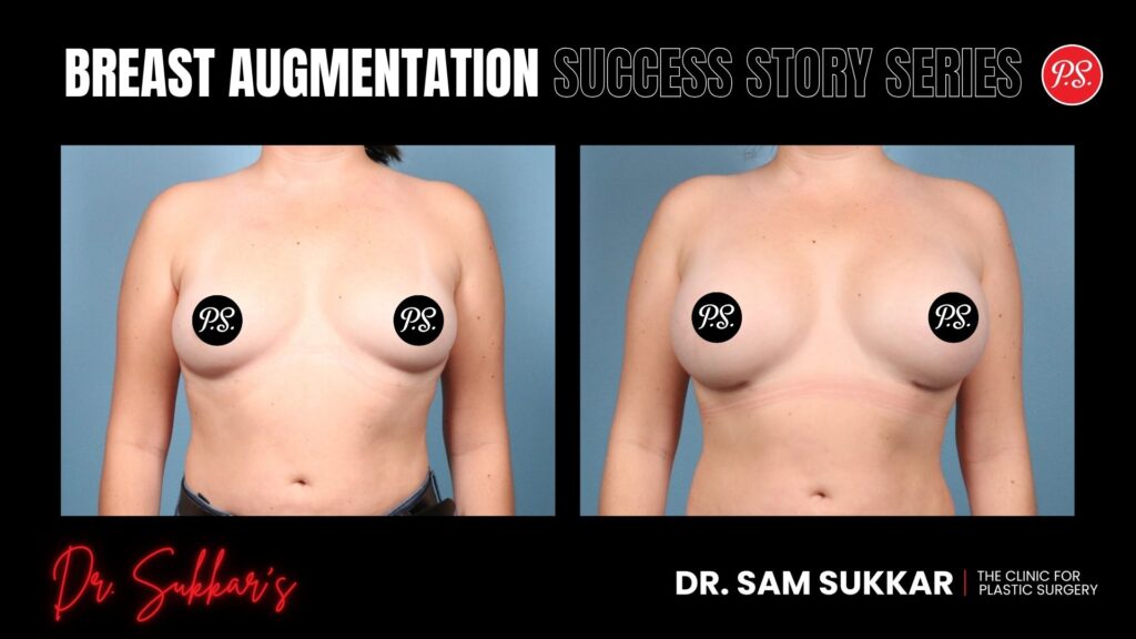 Houston Breast Augmentation: Natural Results for Active Mom - Breast Augmentation Success Story Series in Houston, Texas by Dr. Sam Sukkar, MD