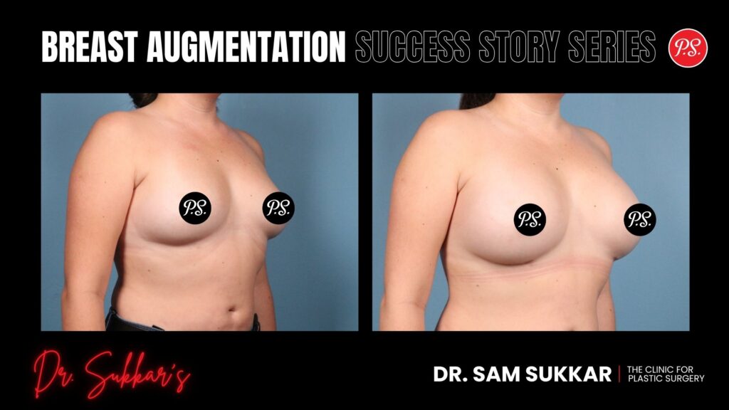 Houston Breast Augmentation: Natural Results for Active Mom - Breast Augmentation Success Story Series in Houston, Texas by Dr. Sam Sukkar, MD