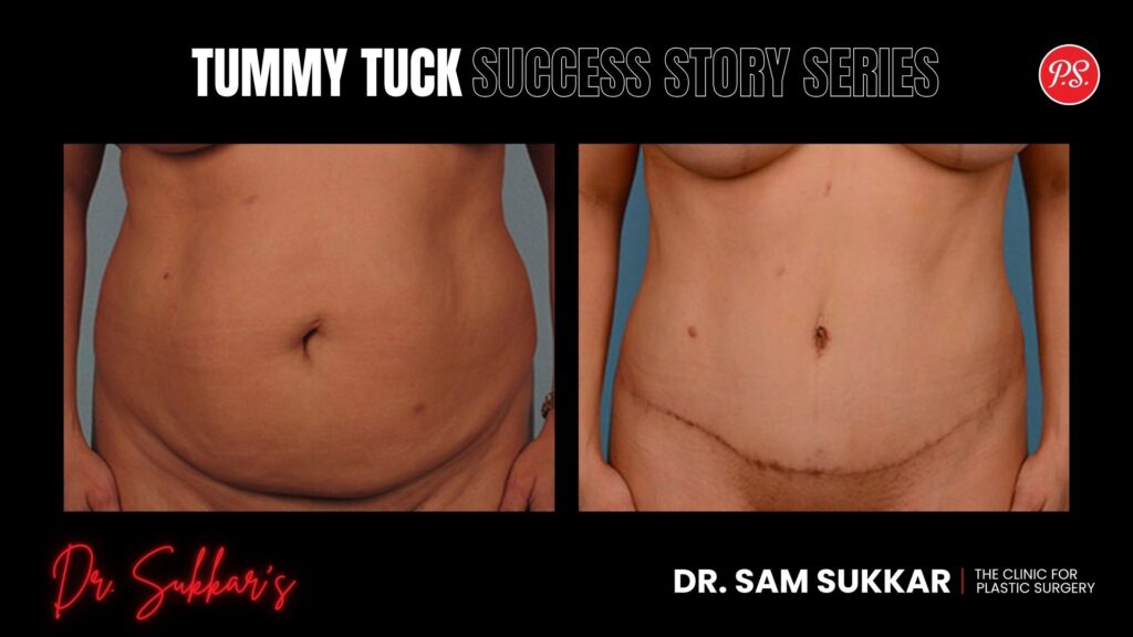 Houston Tummy Tuck: How This Mom Reclaimed Her Pre-Baby Body - Tummy Tuck Success Story Series in Houston, Texas by Dr. Sam Sukkar, MD