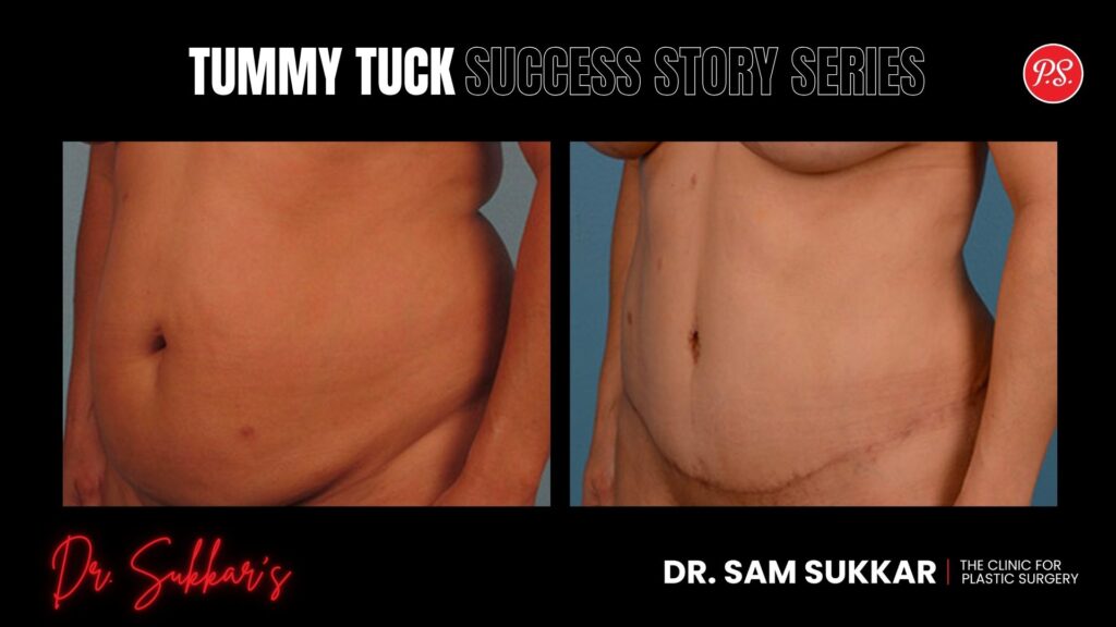 Houston Tummy Tuck: How This Mom Reclaimed Her Pre-Baby Body - Tummy Tuck Success Story Series in Houston, TX by Dr. Sam Sukkar, MD