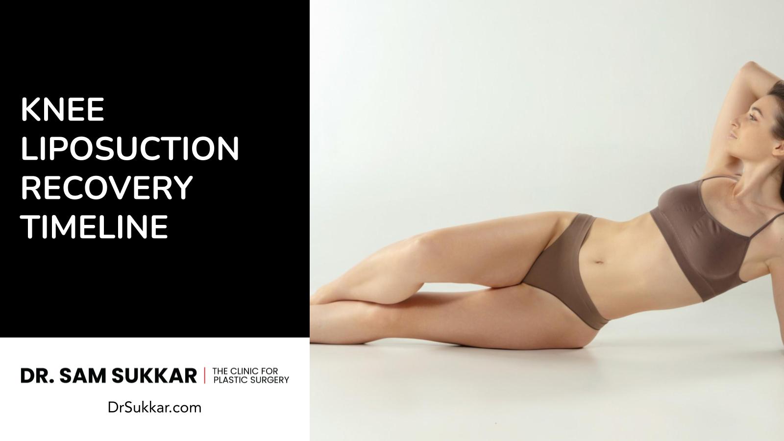 Knee Liposuction Recovery Timeline