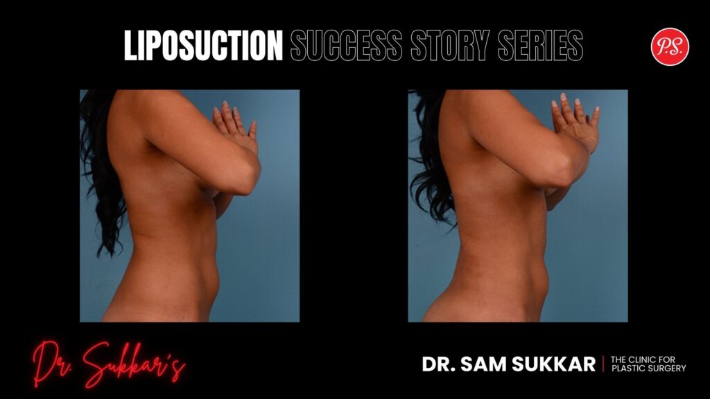 Liposuction & BBL: Former Employee's Flank Sculpting Story - Liposuction Success Story Series in Houston, TX by Dr. Sam Sukkar, MD
