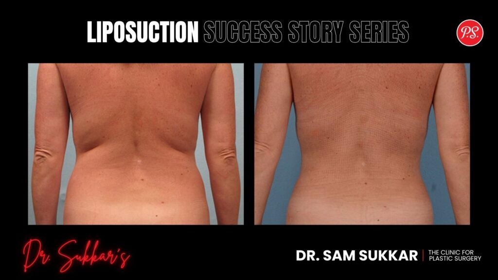 Liposuction Success: Friend Referral Led to Full Transformation - Liposuction Success Story Series in Houston, Texas by Dr. Sam Sukkar, MD