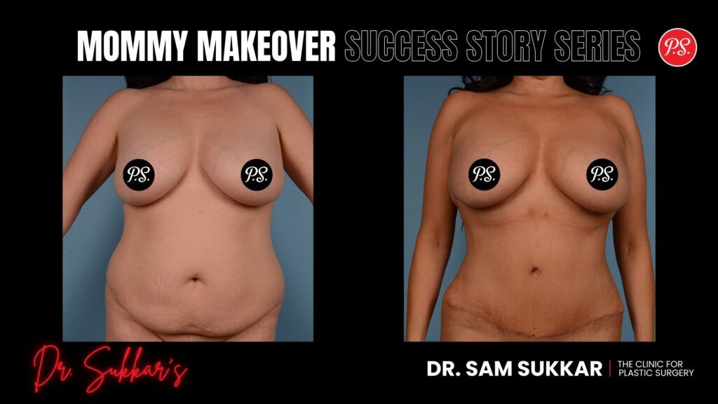 Mommy Makeover After 4 Pregnancies: Houston Mom’s Victory - Mommy Makeover Success Story Series in Houston, Texas by Dr. Sam Sukkar, MD