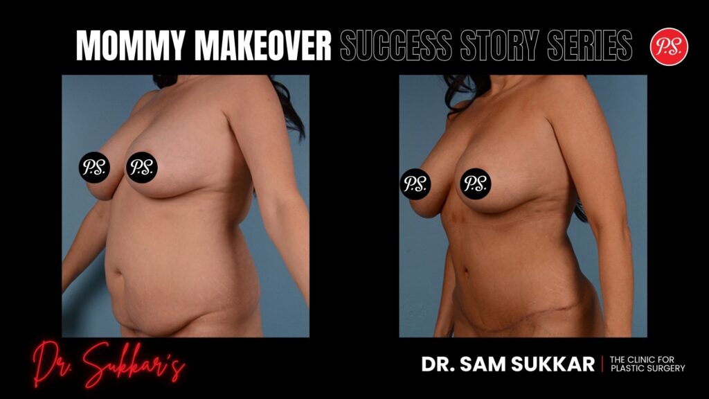 Mommy Makeover After 4 Pregnancies: Houston Mom’s Victory - Mommy Makeover Success Story Series in Houston, TX by Dr. Sam Sukkar, MD