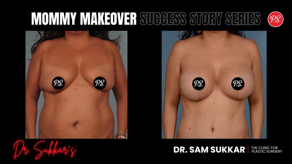 Mommy Makeover Success: Two Procedures, One Loyal Houston Patient - Mommy Makeover Success Story Series in Houston, Texas by Dr. Sam Sukkar, MD