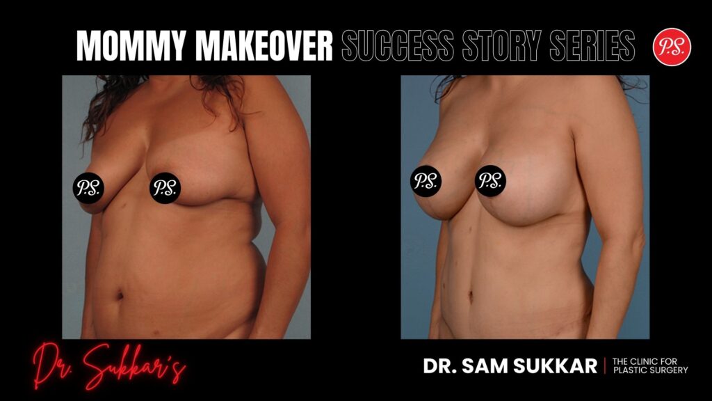Mommy Makeover Success: Two Procedures, One Loyal Houston Patient - Mommy Makeover Success Story Series in Houston, TX by Dr. Sam Sukkar, MD