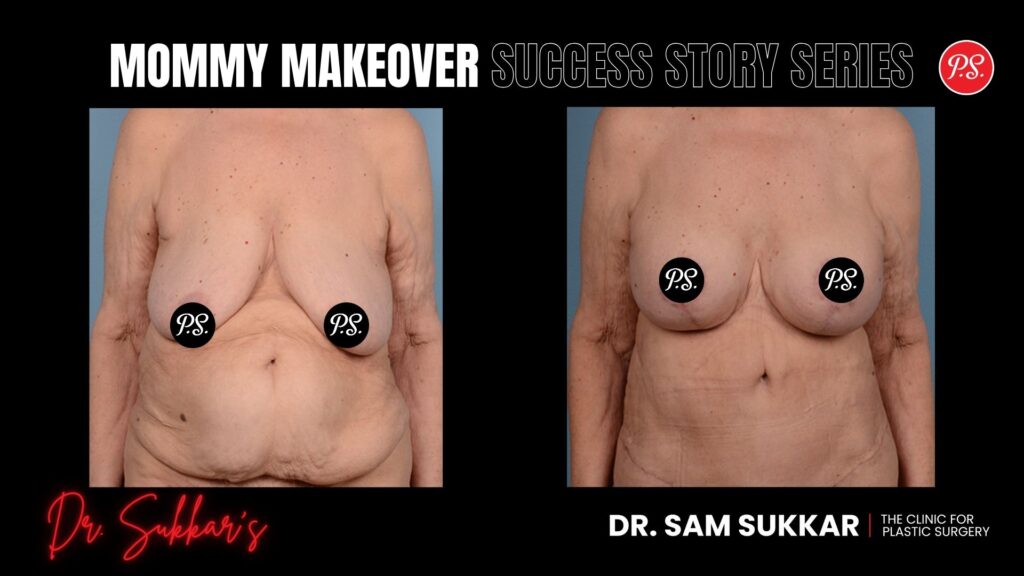 Mommy Makeover at 70: Houston Patient’s Inspiring Journey - Mommy Makeover Success Story Series in Houston, Texas by Dr. Sam Sukkar, MD