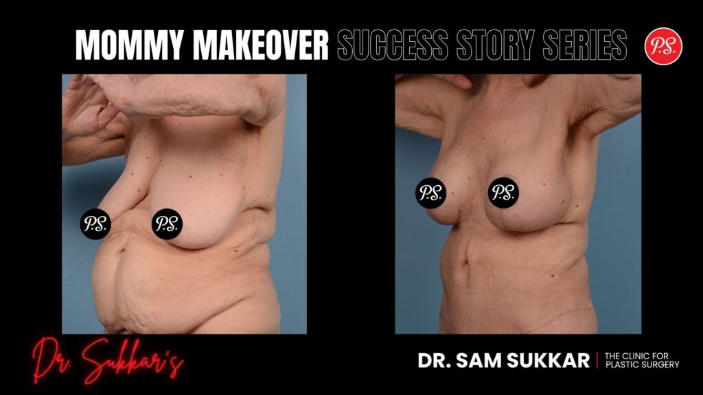 Mommy Makeover at 70: Houston Patient’s Inspiring Journey - Mommy Makeover Success Story Series in Houston, TX by Dr. Sam Sukkar, MD