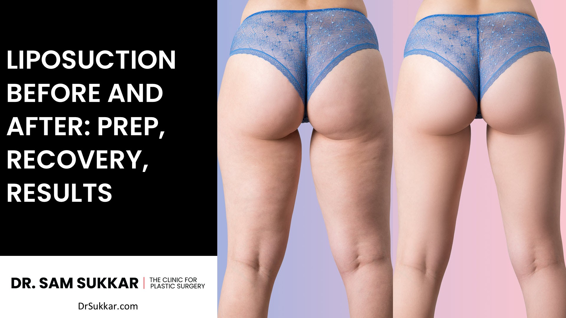 Thigh Liposuction Before And After Transformations