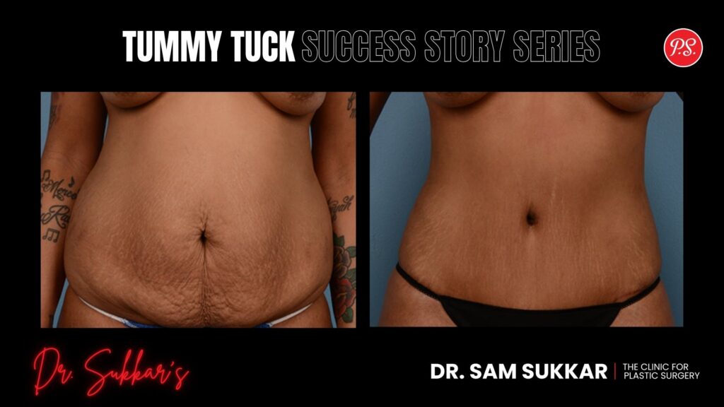 Tummy Tuck Success: Houston VIP Patient’s 3-Friend Referral - Tummy Tuck Success Story Series in Houston, Texas by Dr. Sam Sukkar, MD