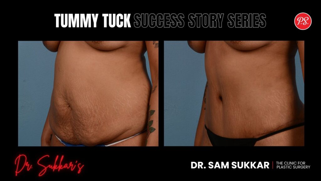 Tummy Tuck Success: Houston VIP Patient’s 3-Friend Referral - Tummy Tuck Success Story Series in Houston, TX by Dr. Sam Sukkar, MD
