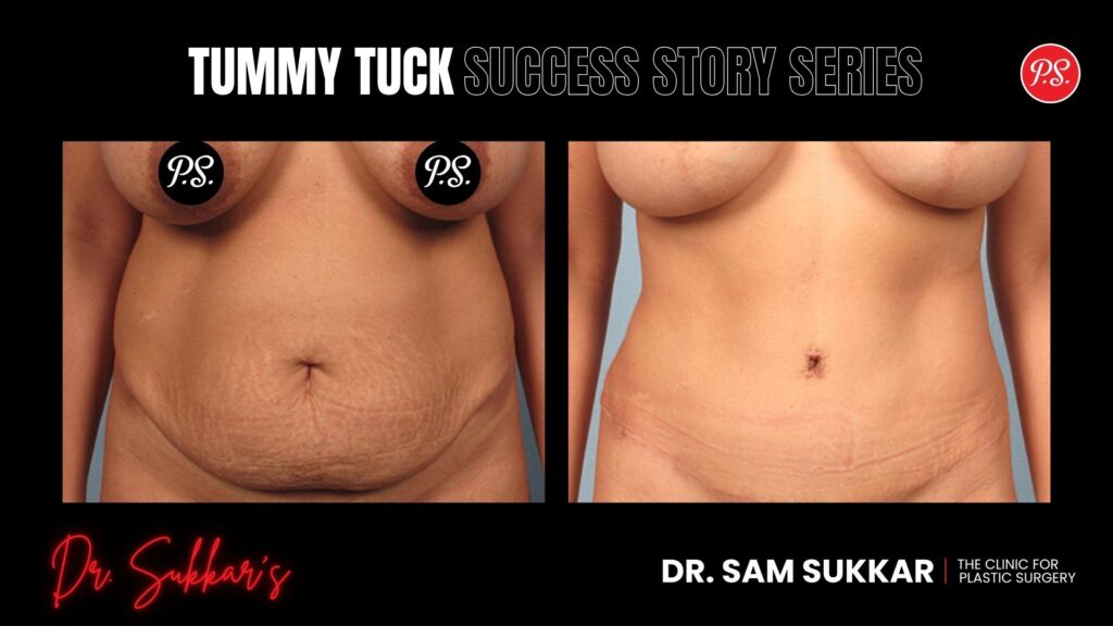 Tummy Tuck at 39: Houston Mom’s Post-C-Section Transformation - Tummy Tuck Success Story Series in Houston, Texas by Dr. Sam Sukkar, MD
