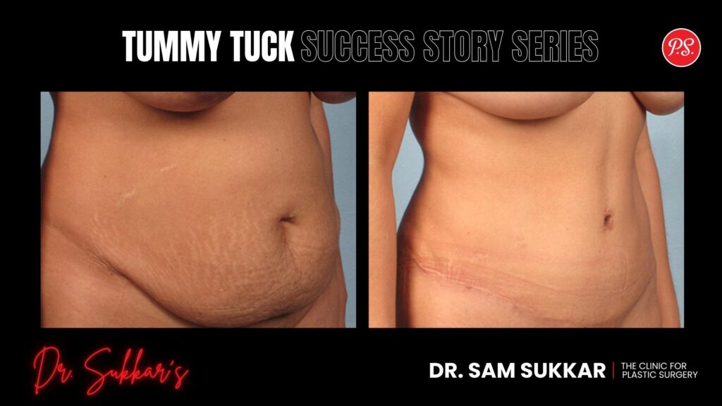 Tummy Tuck at 39: Houston Mom’s Post-C-Section Transformation - Tummy Tuck Success Story Series in Houston, TX by Dr. Sam Sukkar, MD