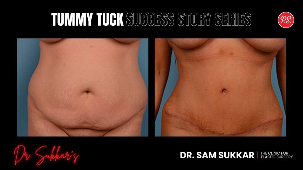 Tummy Tuck with Body Contouring: Houston Mom's Success Story - Tummy Tuck Success Story Series in Houston, Texas by Dr. Sam Sukkar, MD