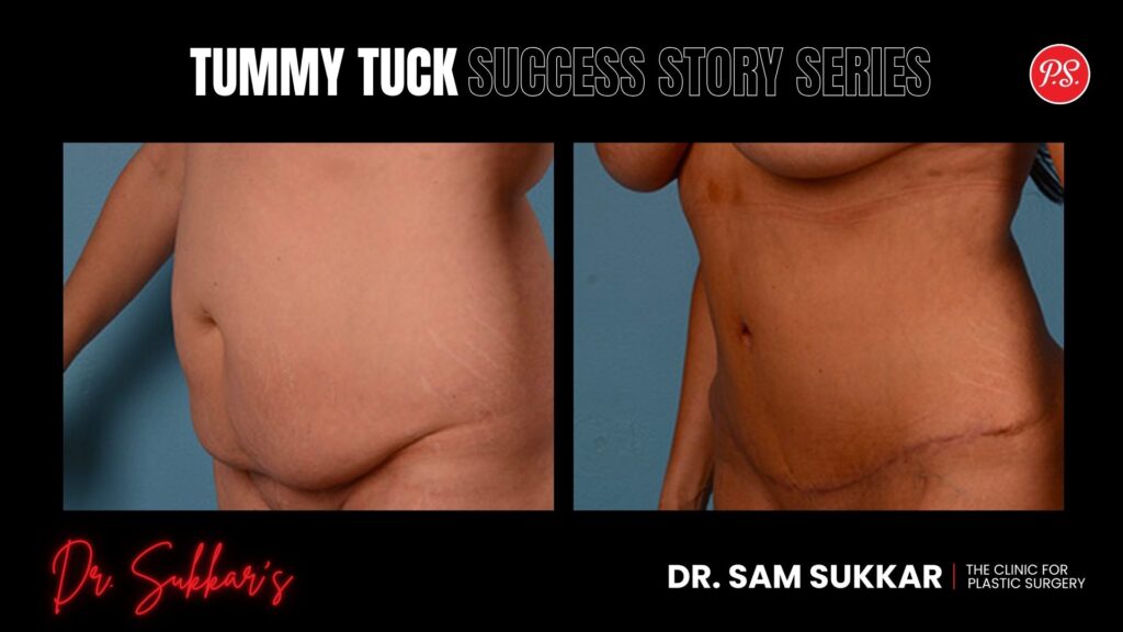 Tummy Tuck with Body Contouring: Houston Mom's Success Story - Tummy Tuck Success Story Series in Houston, TX by Dr. Sam Sukkar, MD