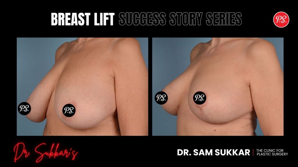 Breast Lift at 63: How This Houston Patient Reclaimed Her Life - Breast Lift Success Story Series in Houston, TX by Dr. Sam Sukkar, MD
