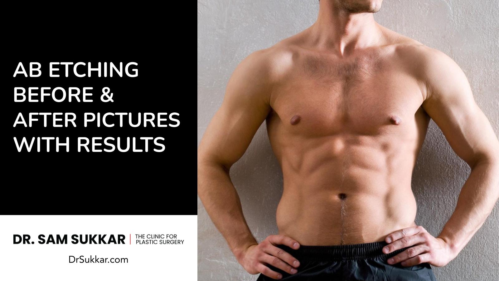 Ab Etching Before & After Pictures With Results