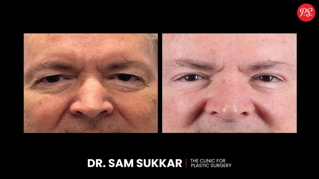 Blepharoplasty Before & After Transformations 1 by Dr. Sam Sukkar, MD