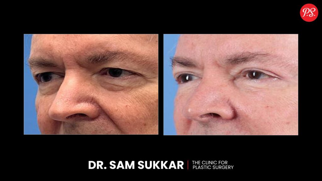 Blepharoplasty Before & After Transformations 2 by Dr. Sam Sukkar, MD