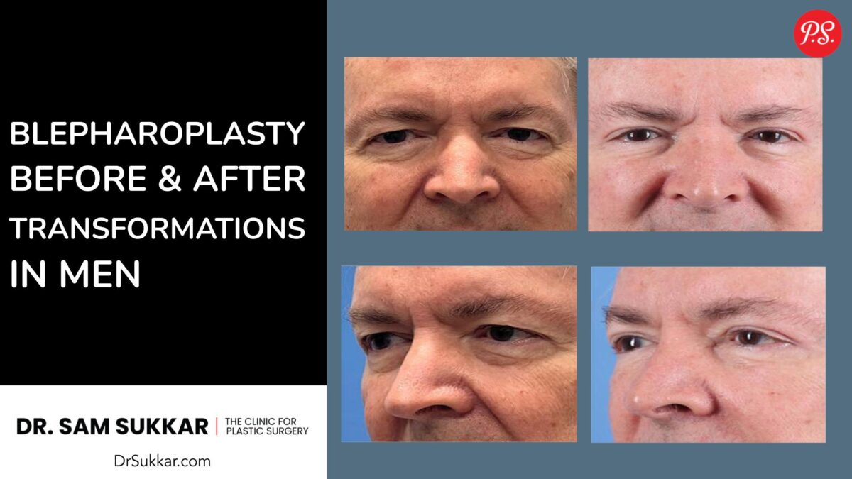 Blepharoplasty Before & After Transformations in Men by Dr. Sam Sukkar, MD