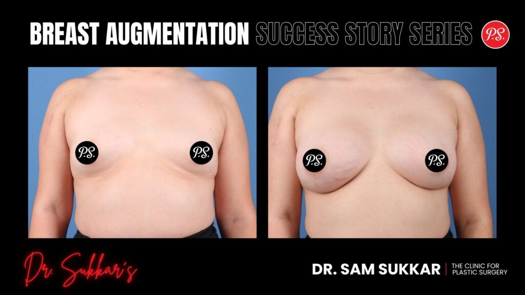 Breast Augmentation at 29: Houston Patient’s Natural Enhancement - Breast Augmentation Success Story Series in Houston, Texas by Dr. Sam Sukkar, MD