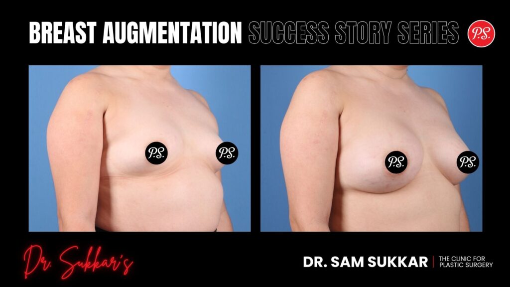 Breast Augmentation at 29: Houston Patient’s Natural Enhancement - Breast Augmentation Success Story Series in Houston, TX by Dr. Sam Sukkar, MD