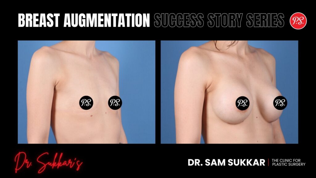 Breast Augmentation at 30: Houston Patient’s Journey to Confidence - Breast Augmentation Success Story Series in Houston, TX by Dr. Sam Sukkar, MD