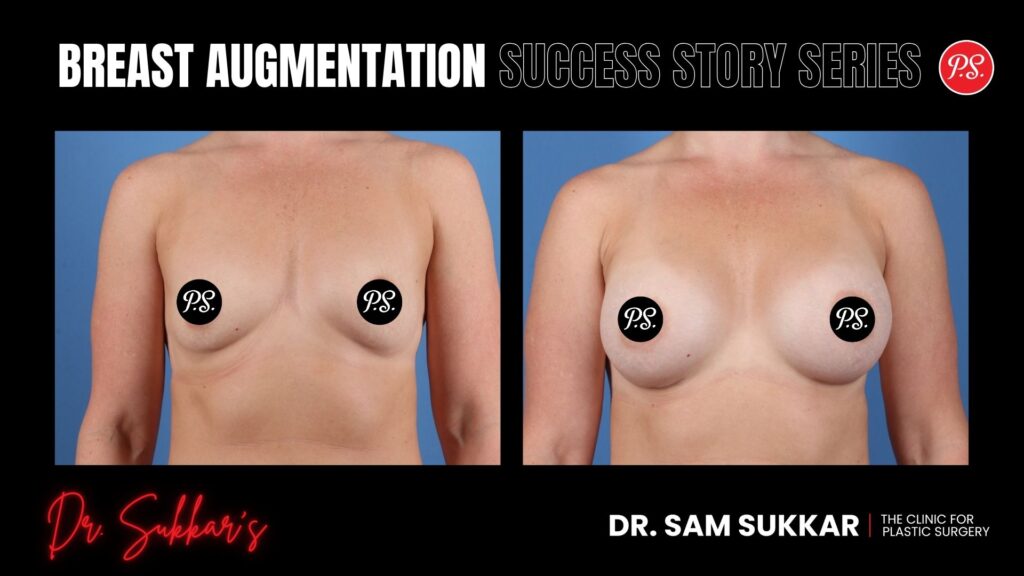 Breast Augmentation at 41: Houston Mom's Confidence Transformation - Breast Augmentation Success Story Series in Houston, Texas by Dr. Sam Sukkar, MD