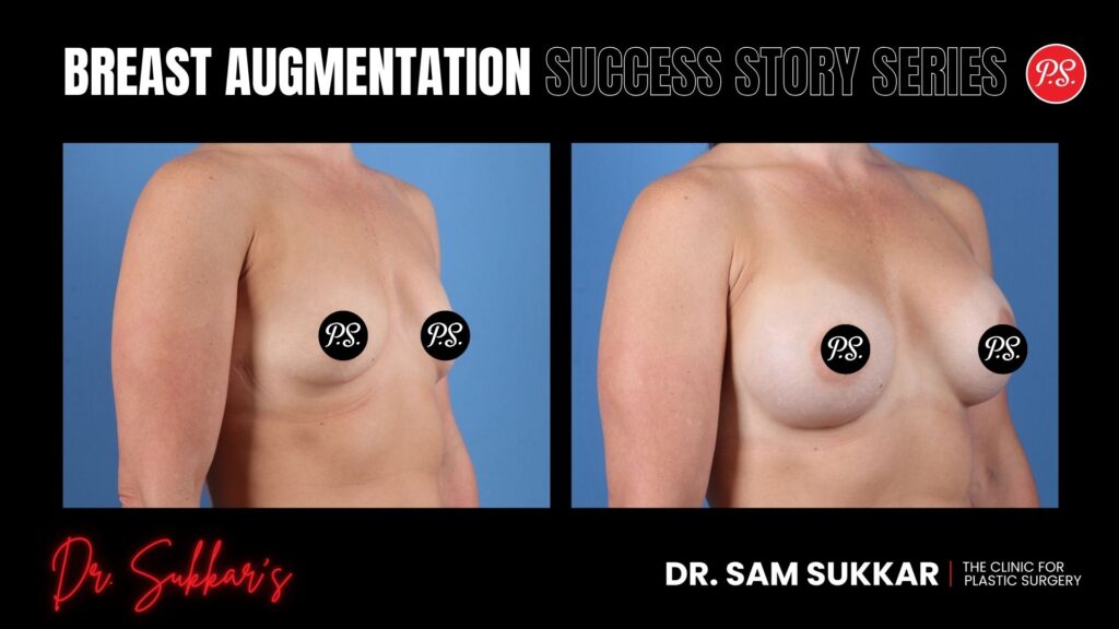 Breast Augmentation at 41: Houston Mom's Confidence Transformation - Breast Augmentation Success Story Series in Houston, TX by Dr. Sam Sukkar, MD