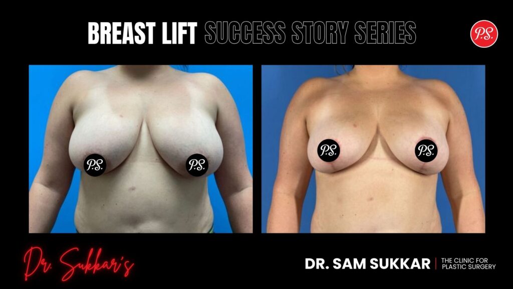 Breast Lift at 41: Houston Mom’s Natural Rejuvenation - Breast Lift Success Story Series in Houston, Texas by Dr. Sam Sukkar, MD
