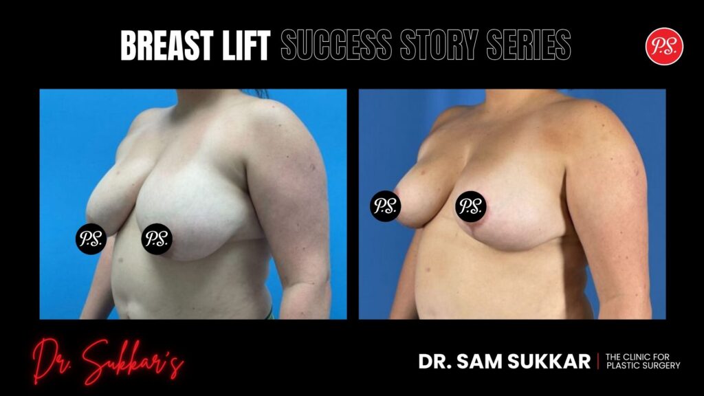 Breast Lift at 41: Houston Mom’s Natural Rejuvenation - Breast Lift Success Story Series in Houston, TX by Dr. Sam Sukkar, MD