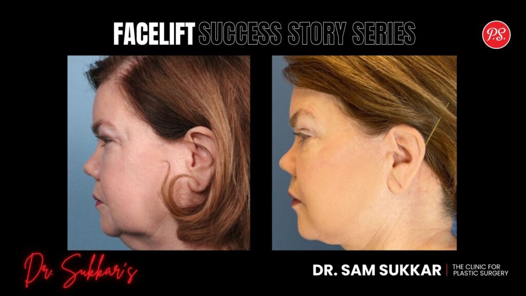 Facelift at 62: Houston Patient’s Natural Rejuvenation - Facelift Success Story Series in Houston, TX by Dr. Sam Sukkar, MD