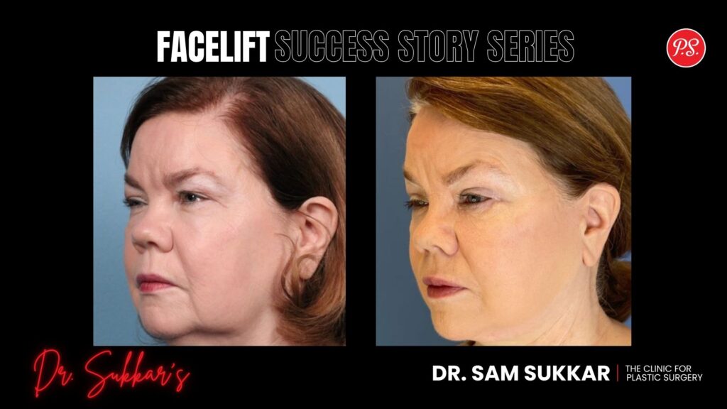 Facelift at 62: Houston Patient’s Natural Rejuvenation - Facelift Success Story Series in Houston, Texas by Dr. Sam Sukkar, MD