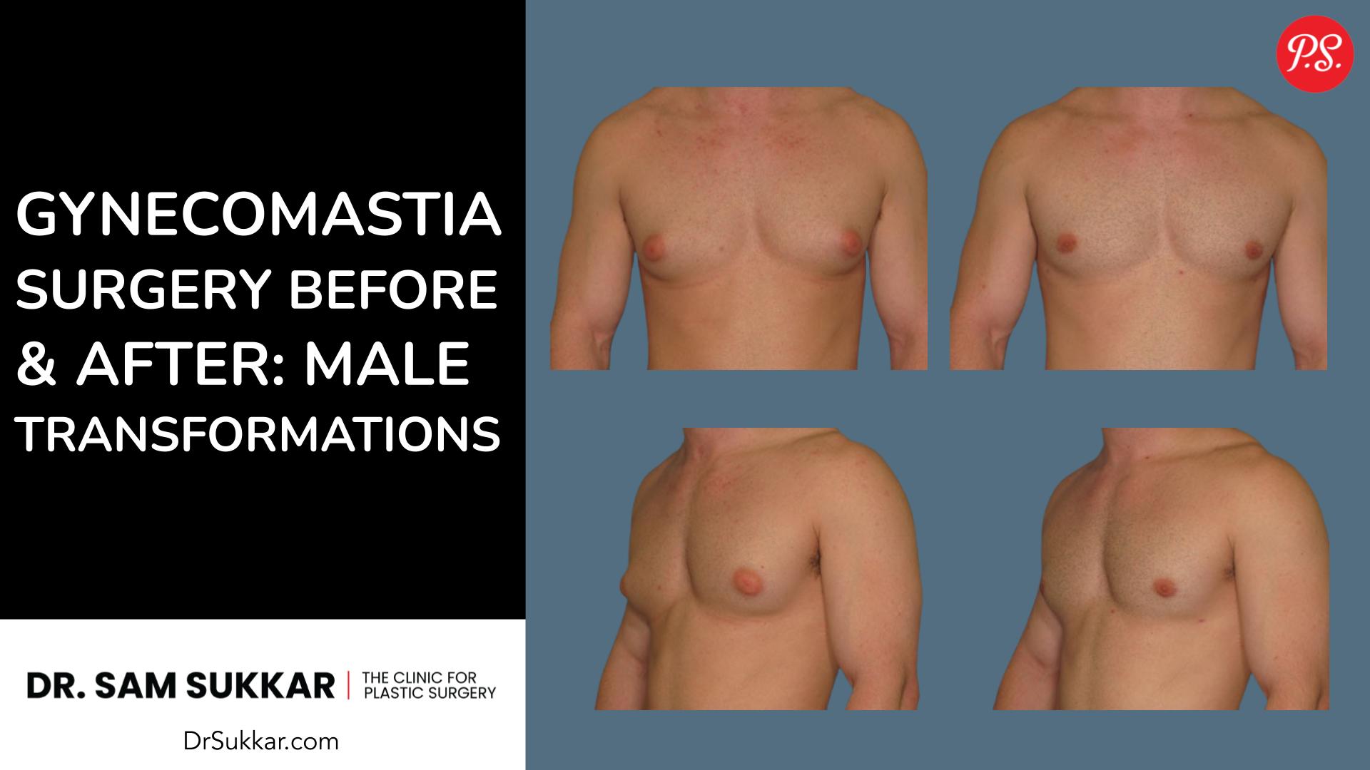 Gynecomastia Surgery Before and After: Chest Transformations for Men
