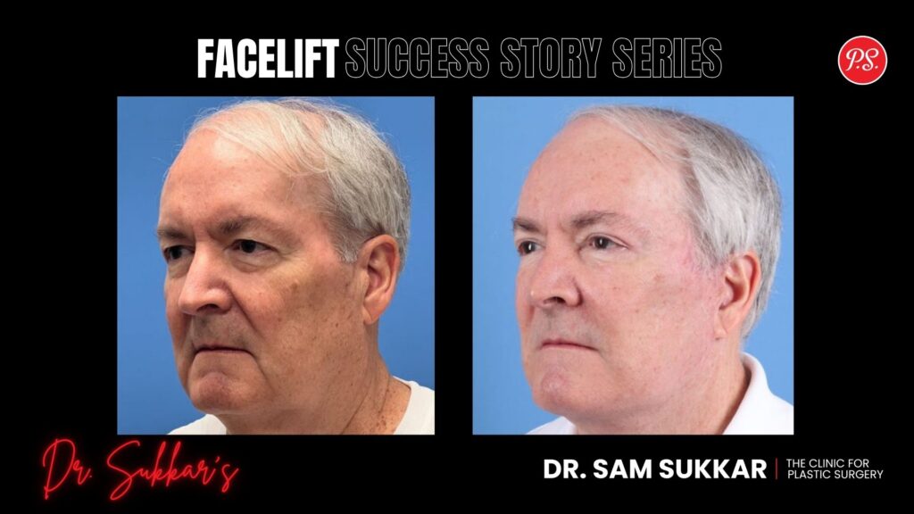 Houston Facelift at 63: Male Executive’s Transformation - Facelift Success Story Series in Houston, Texas by Dr. Sam Sukkar, MD