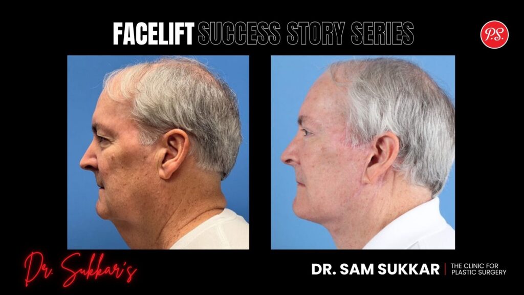 Houston Facelift at 63: Male Executive’s Transformation - Facelift Success Story Series in Houston, TX by Dr. Sam Sukkar, MD